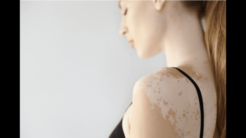 vitiligo women
