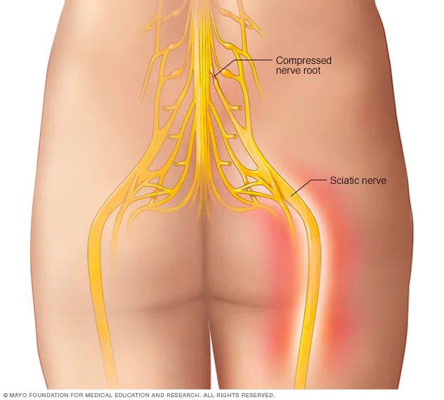 Exercises That May Support Sciatica Treatment and Recovery